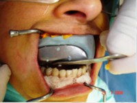 /album/galeria-de-fotos-carga-imediata-apos-exodontia-atraumatica-/carga-imediata-com-exodontia-atraumatica7-jpg/